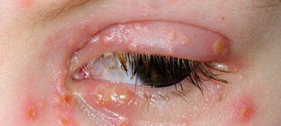 Симптомы герпеса на глазах