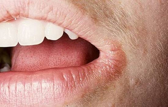 Ангулярный хейлит (заеды в уголках рта) — причины, симтомы, лечение, фото